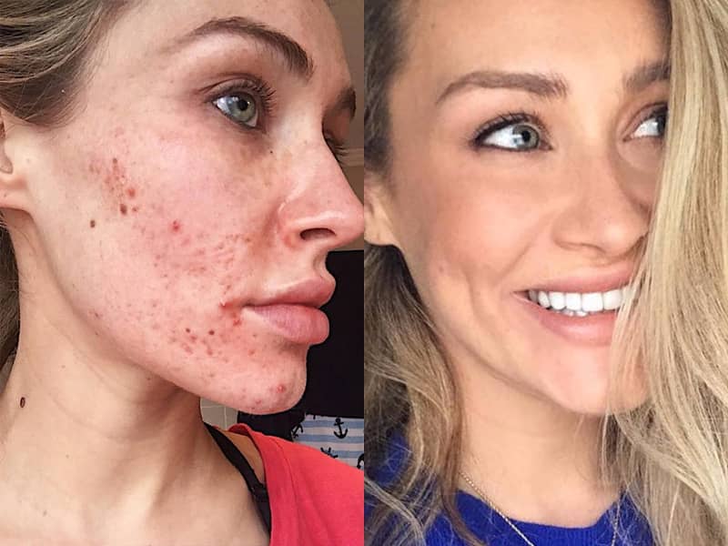 How Laser Treatment Helps Treat Skin Acne
